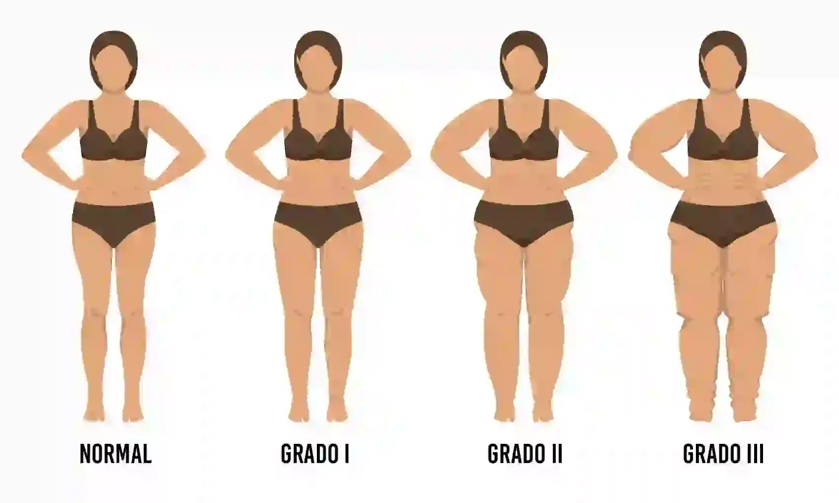 Nutrilipedema imagen